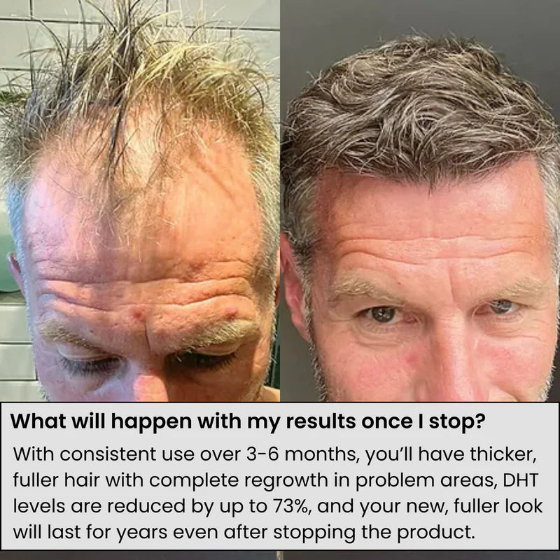 AlphaInfuse Microneedling Hair Regrowth System – Made with Panax Ginseng, Eclipta Prostrata, Peppermint & Ginger Root, Infused Deep into Your Scalp to Stop Hair Loss and Regrow Thicker Hair in 4 Weeks