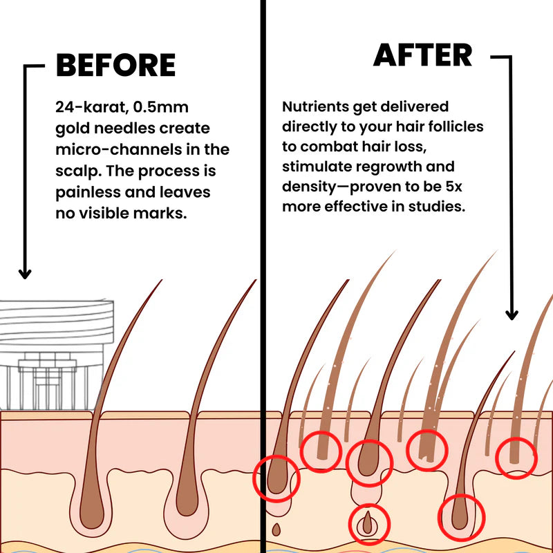 AlphaInfuse Microneedling Hair Regrowth System – Made with Panax Ginseng, Eclipta Prostrata, Peppermint & Ginger Root, Infused Deep into Your Scalp to Stop Hair Loss and Regrow Thicker Hair in 4 Weeks